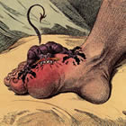Crise de goutte orteil du pied